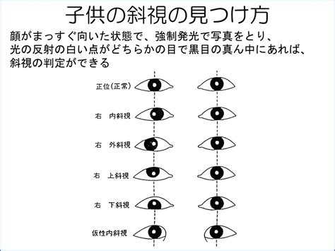 斜視|斜視について